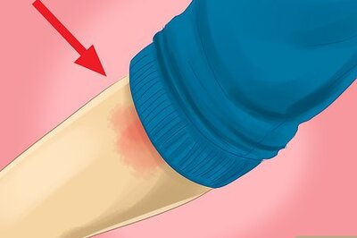 How to Relieve Blister Pain