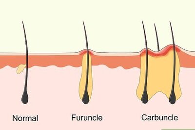 How to Recognize and Treat Carbuncles at Home