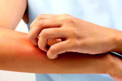 What You Need to Know About Yeast Infections in Hot and Humid Weather