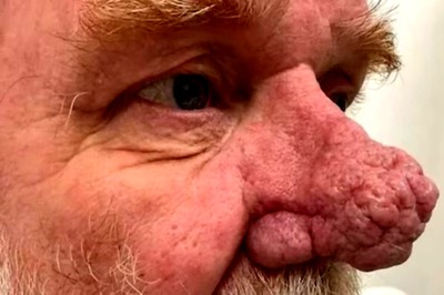 This Ex-Navy Sailor's Transformation After He Developed Enlarged Nose Deserves Applause