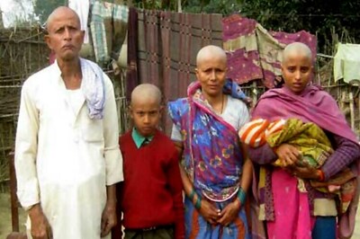 Handpump water turns Bihar village family bald, authorities wait for report