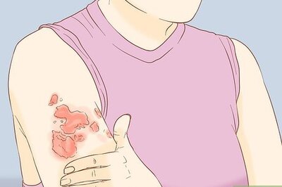 Taking Care of Fungal Skin Infections