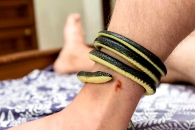 This Video Shows What Happens To Human Blood After Snakebite