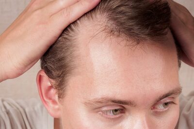 How To Treat Alopecia Naturally Using Herbs? Experts Answer
