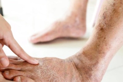 How To Take Care Of Your Feet If You Are Diabetic