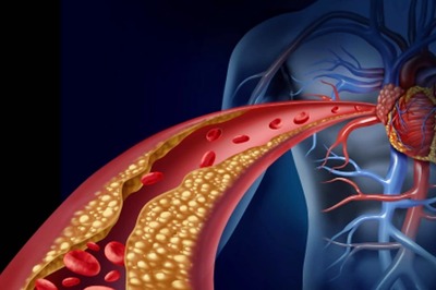 Good Cholesterol May Be A Risk Factor For Cardiovascular Disease: Study