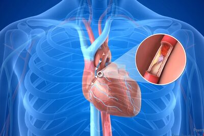 What You Need To Know About Coronary Artery Bypass Grafting