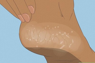 How to Get Rid of Dry Skin on Feet