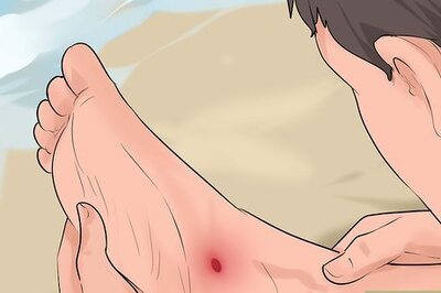 How to Identify and Treat Injuries From Stingrays and Sea Urchins