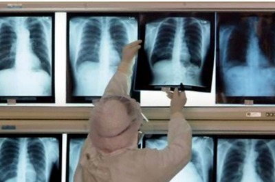 AI-model Developed that Could Tell Age From Chest X-ray