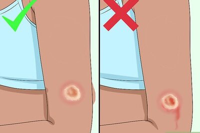 How to Get Rid of a Scab