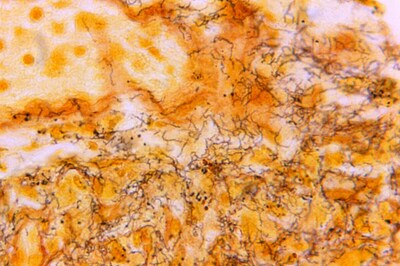 Syphilis Epidemic Grips US: 2022 Cases Hit Highest Count Since 1950, But Gonorrhea Shows Decline