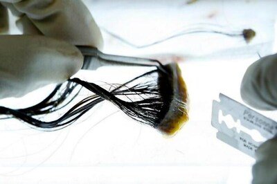 Some Skin Cancers May Start in Hair Follicles, Says Study