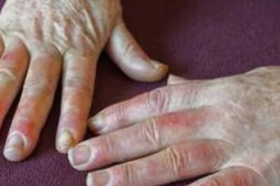 What is Raynaud’s Syndrome and How To Prevent It In Cold Conditions