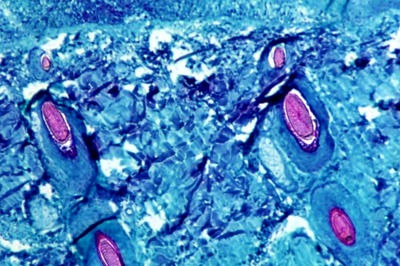 WHO Calls Emergency Meet as Monkeypox Cases Top 100 in Europe; Could the Disease be Next Covid? EXPLAINED