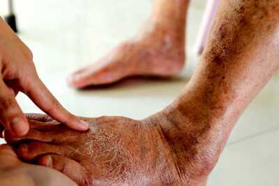 Numbness To Cramps, 6 Lesser-known Foot-related Diabetes Symptoms