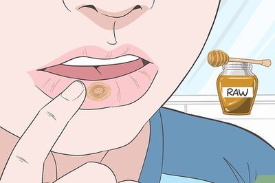 How to Treat Mouth Ulcers Naturally