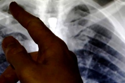 Delhi Doctors Observe Rise in Tuberculosis Cases Among Post-Covid Patients