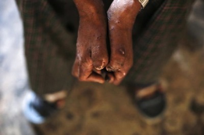 2 Lakh Leprosy Cases Reported Every Year, India Accounts For More Than Half of Them: WHO