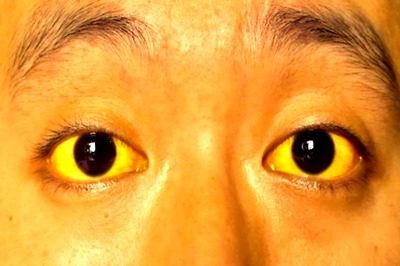 Food And Liquid Items You Must Have While Recovering From Jaundice