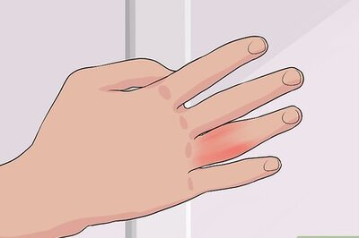 How to Know if You Sprained Your Finger