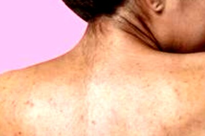 Beauty Tips: 5 Effective Ways To Get Rid Of Bacne And Blemishes