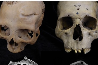 Cut Marks On 4,000-Year-Old Skulls Show Egyptians Tried To Treat Cancer