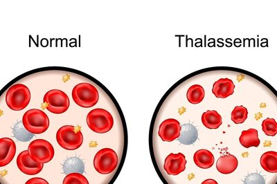 Thalassemia Awareness: Why Aspiring Parents Require To Undergo Screening?