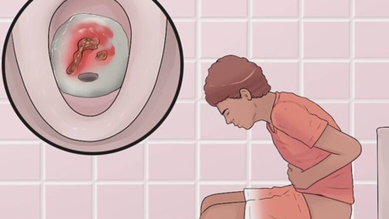 How to Distinguish Ulcerative Colitis from Similar Conditions