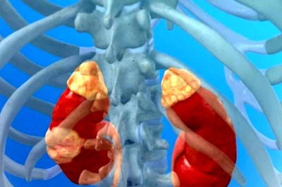 Kidney Cancer: Know Early Symptoms, Treatment and Prevention