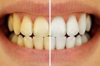 White Spots on Teeth? Here are Its Causes and Remedies