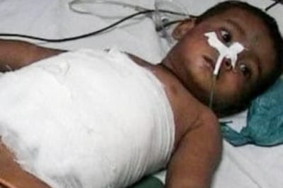 Boy survives after iron bar pierces his abdomen