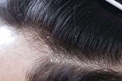 Breaking Barriers: The Rise of Hair Transplants Among India's Aspirational Millennials