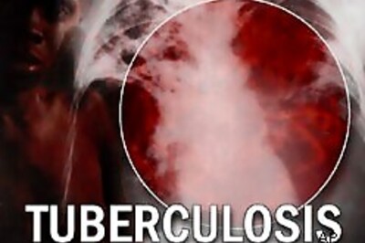 Tuberculosis poses as threat to Europe