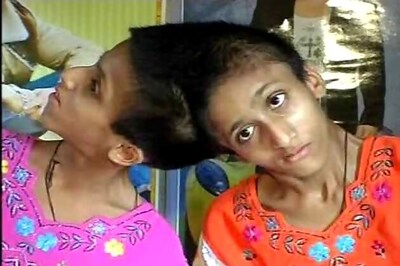 SC orders Bihar government to take care of conjoined twins