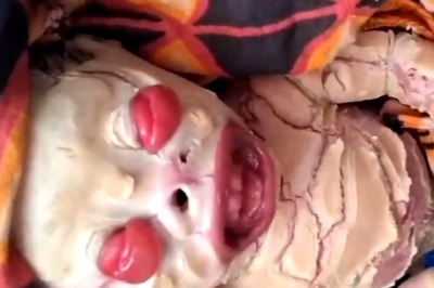 Child Born With Teeth And Devoid Of Skin In Bihar Shocks Localsc